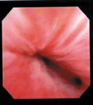 Cystoscopy with visualisation of urethral diverticulum ostium.