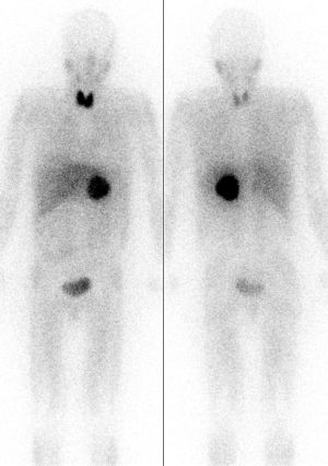 Pheochromocytoma MIBG