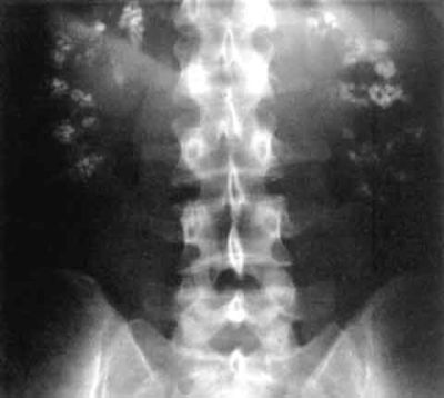 Nephrocalcinosis. Source: Wikipedia